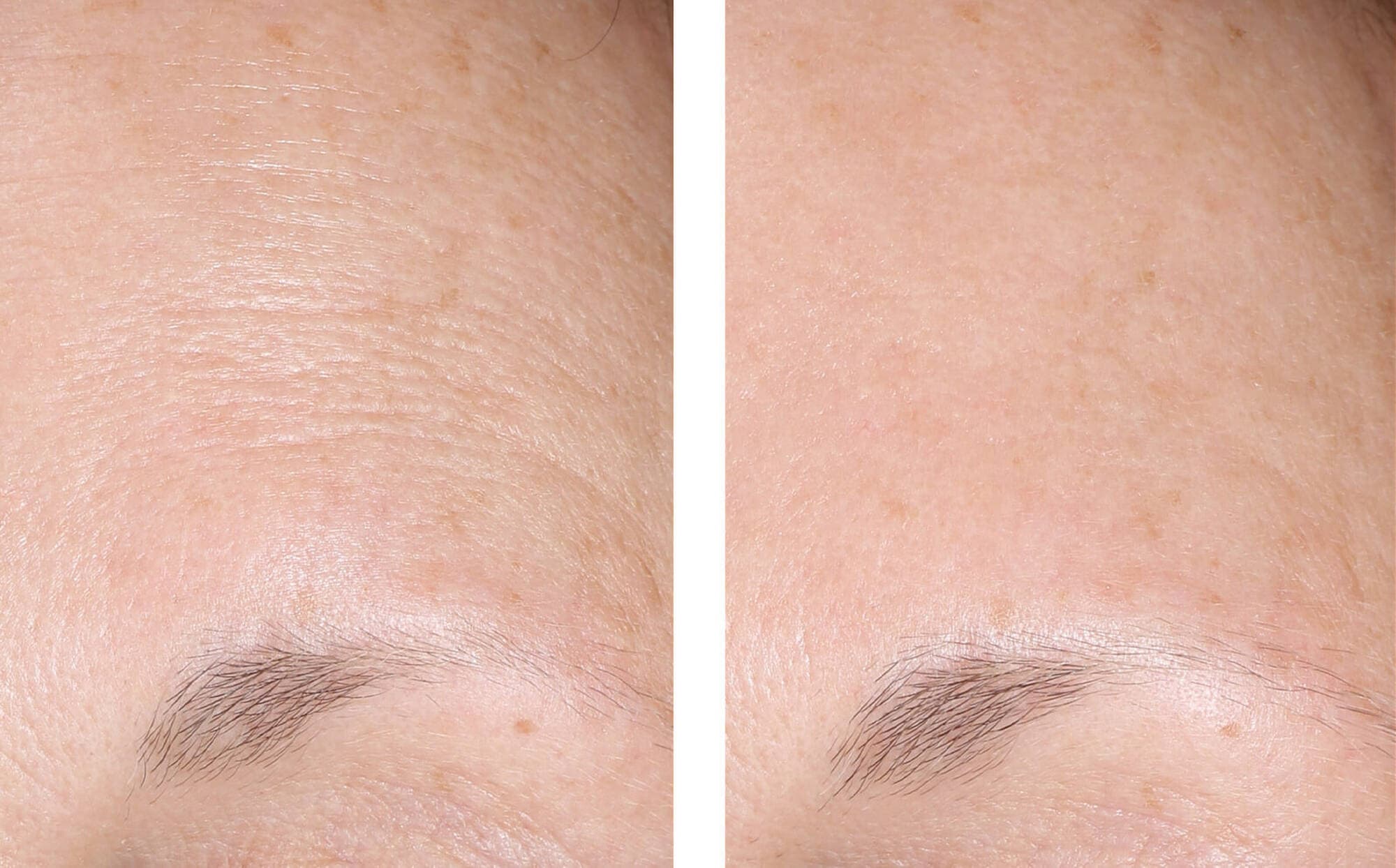 Before and after photos of a skincare protocol, Atelier Med selection.