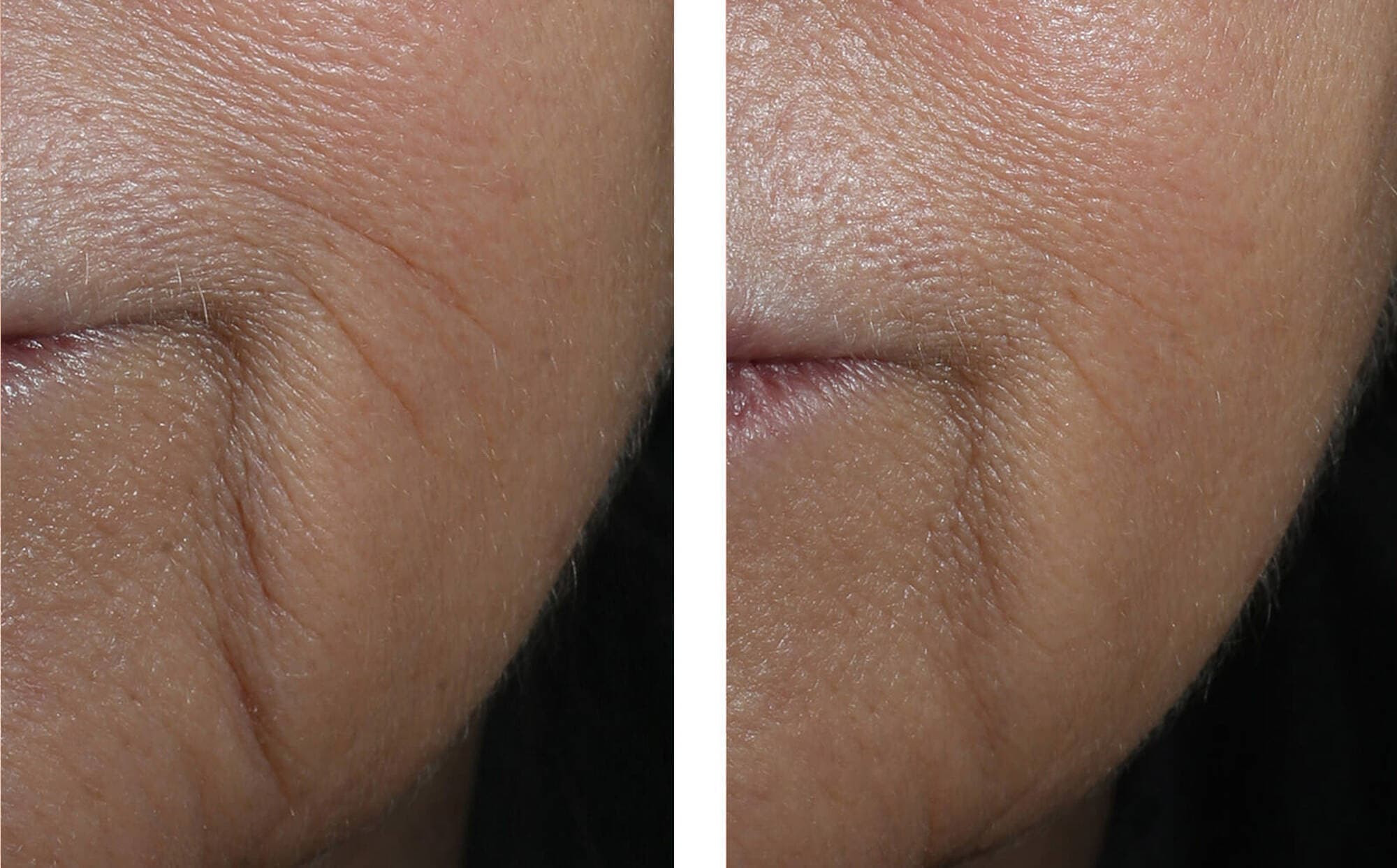 Before and after photos of a skincare protocol, Atelier Med selection.