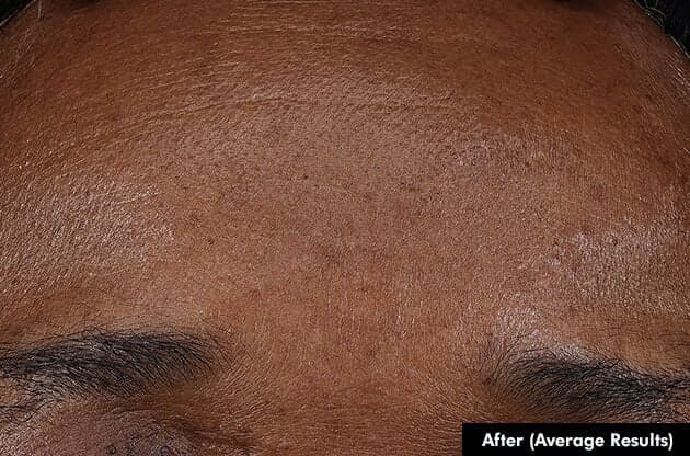 Before and after photos of a skincare protocol, Atelier Med selection.